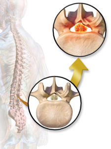 Spinal_Stenosis